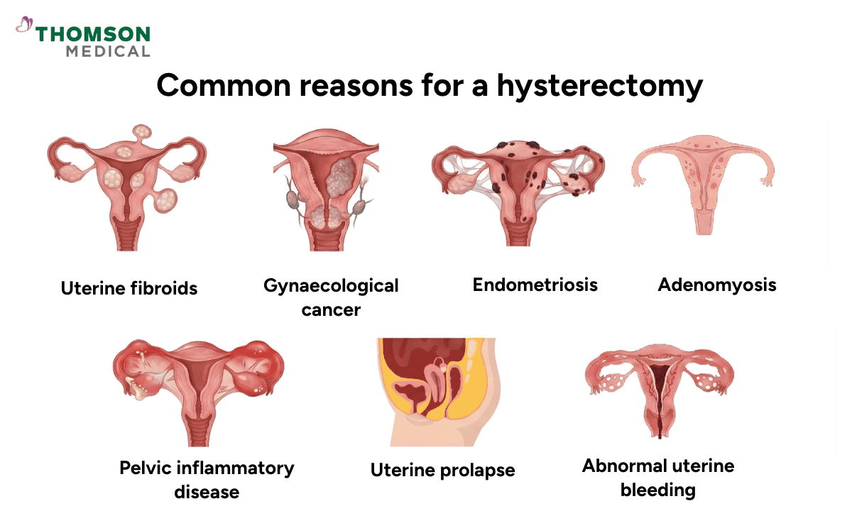 A medical infographic on common reasons for a hysterectomy, showing seven anatomical illustrations: uterine fibroids, gynecological cancer, endometriosis, adenomyosis, pelvic inflammatory disease, uterine prolapse, and abnormal uterine bleeding.
