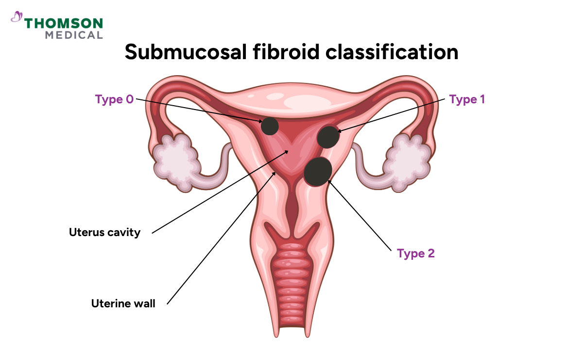 Illustration of submucosal fibroids classification
