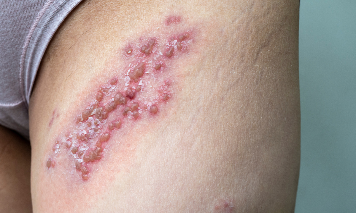 symptoms of genital herpes