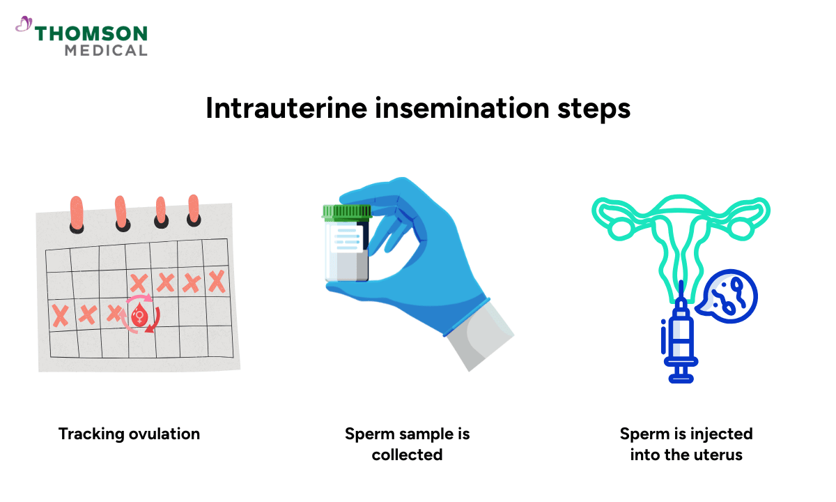 illustration of the steps during IUI
