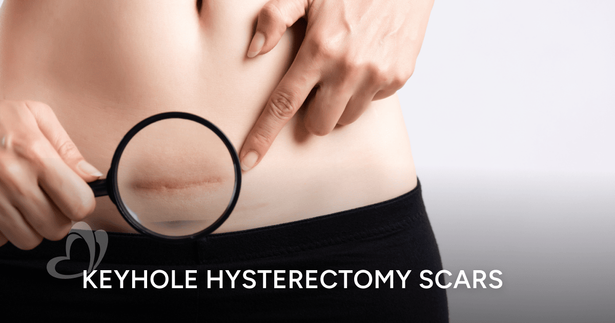 Keyhole Hysterectomy Scars: Locations, Healing, and Aftercare | Thomson  Medical