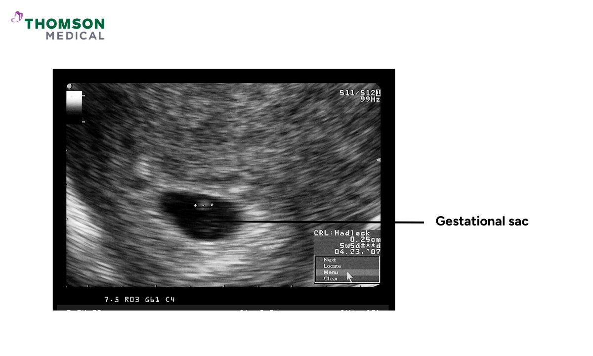 blog-image_obgyn_gestational sac.png