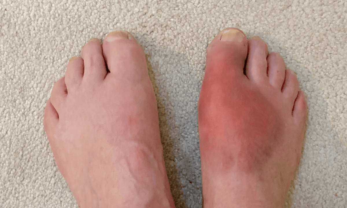 image of a big toe experiencing gout attack