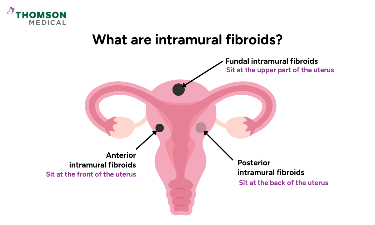 Illustration shows an intramural uterine fibroids