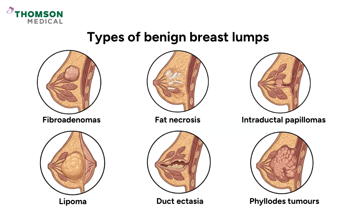 Illustration shows the type of benign breast lumps