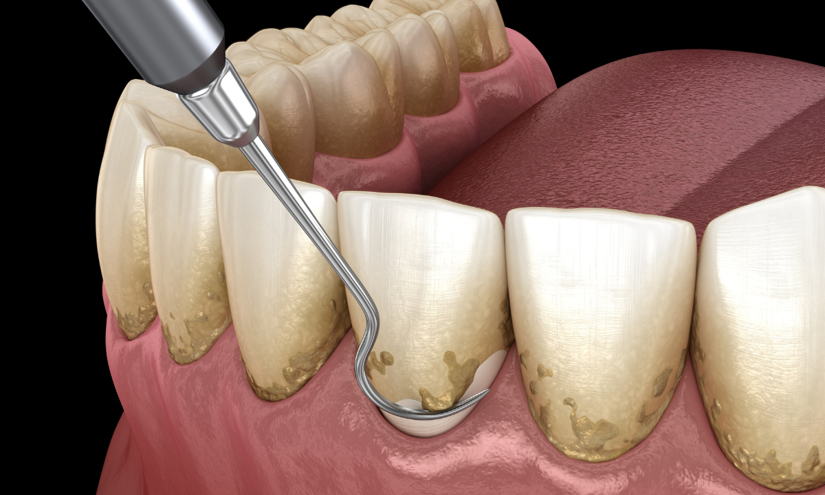Illustration of dental scaling and root planing
