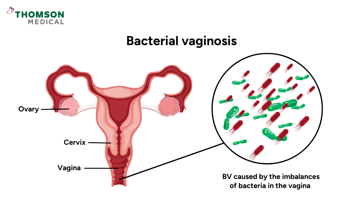 Bacterial vaginosis