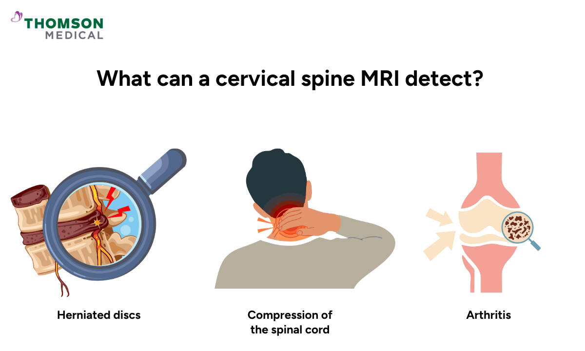 Illustration of what a cervical spine MRI can detect