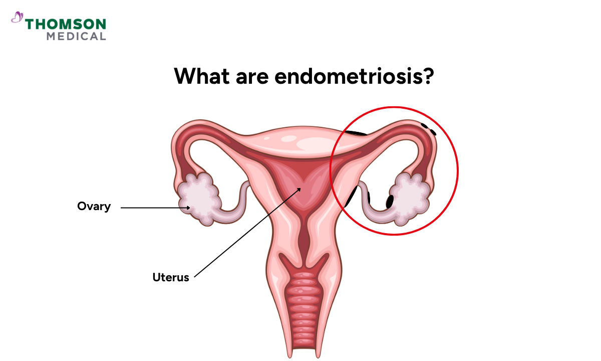 Illustration of endometriosis