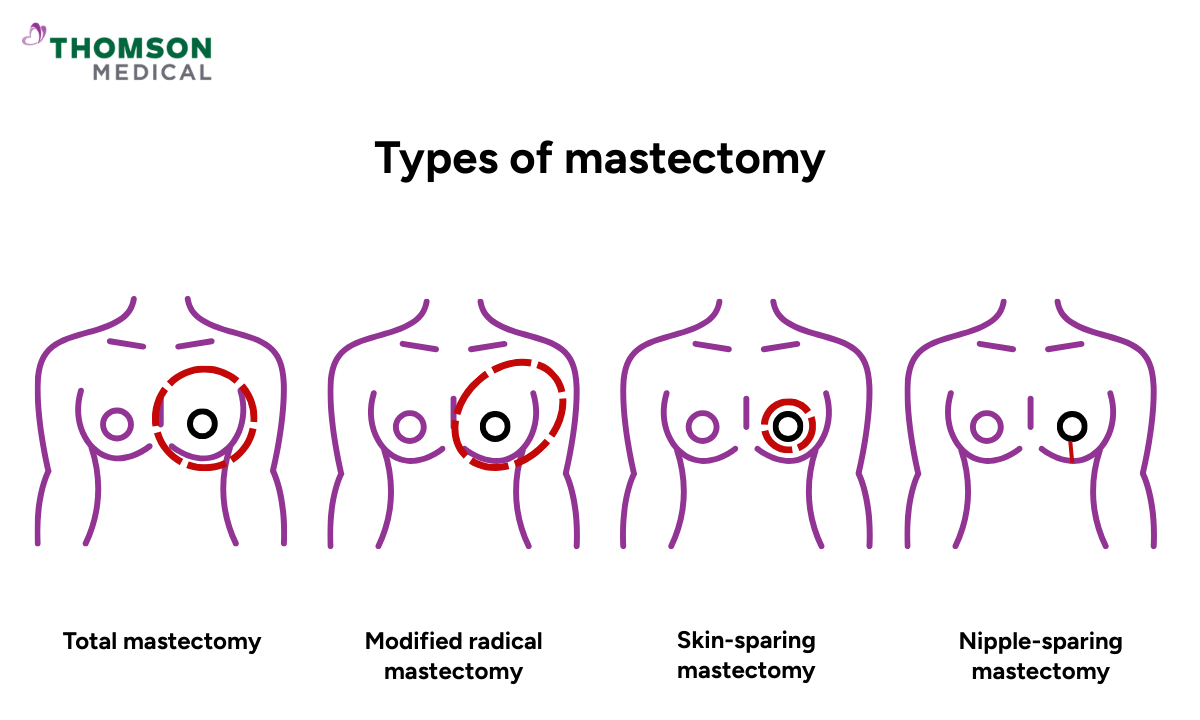 Illustration of different types of mastectomy