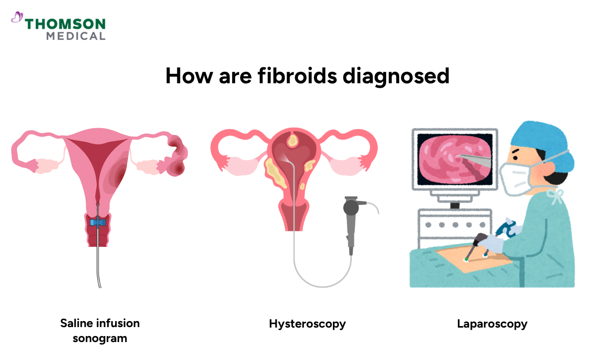 Illustration shows how are fibroids diagnosed