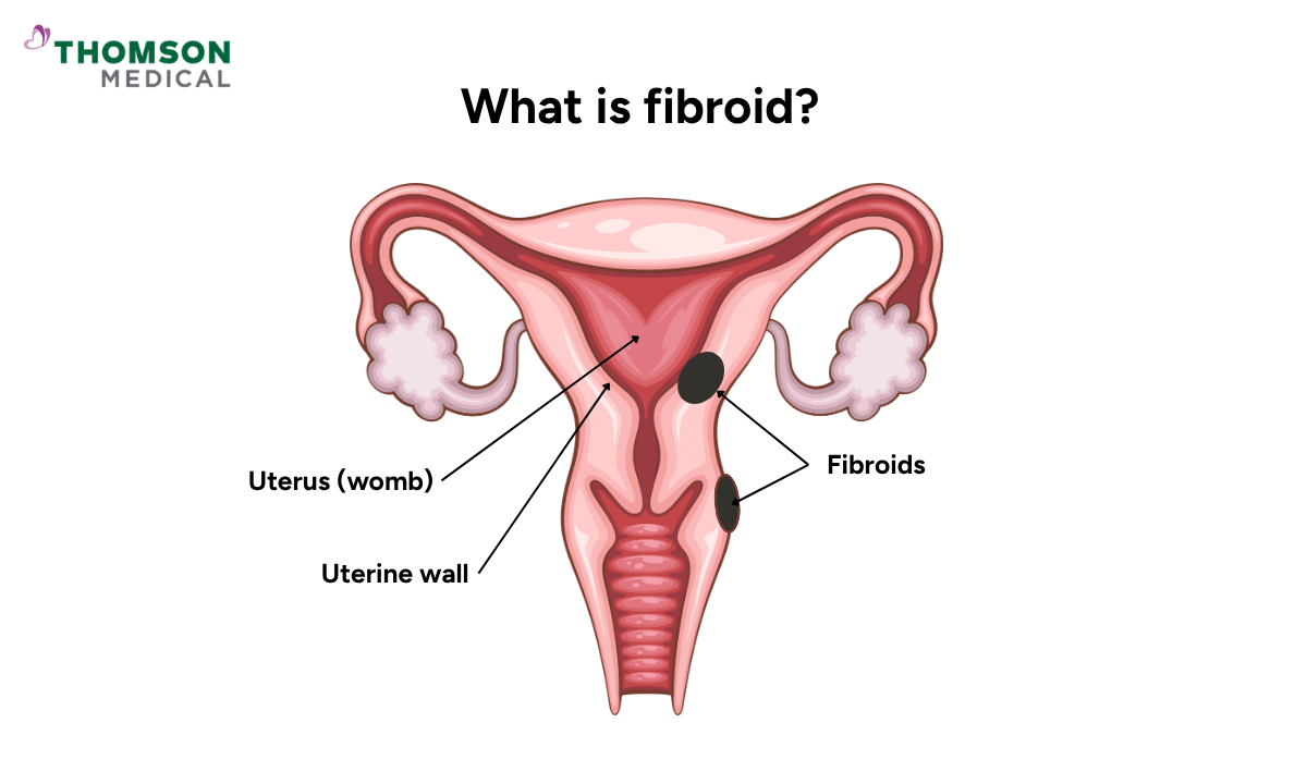 illustration of what is uterine fibroids