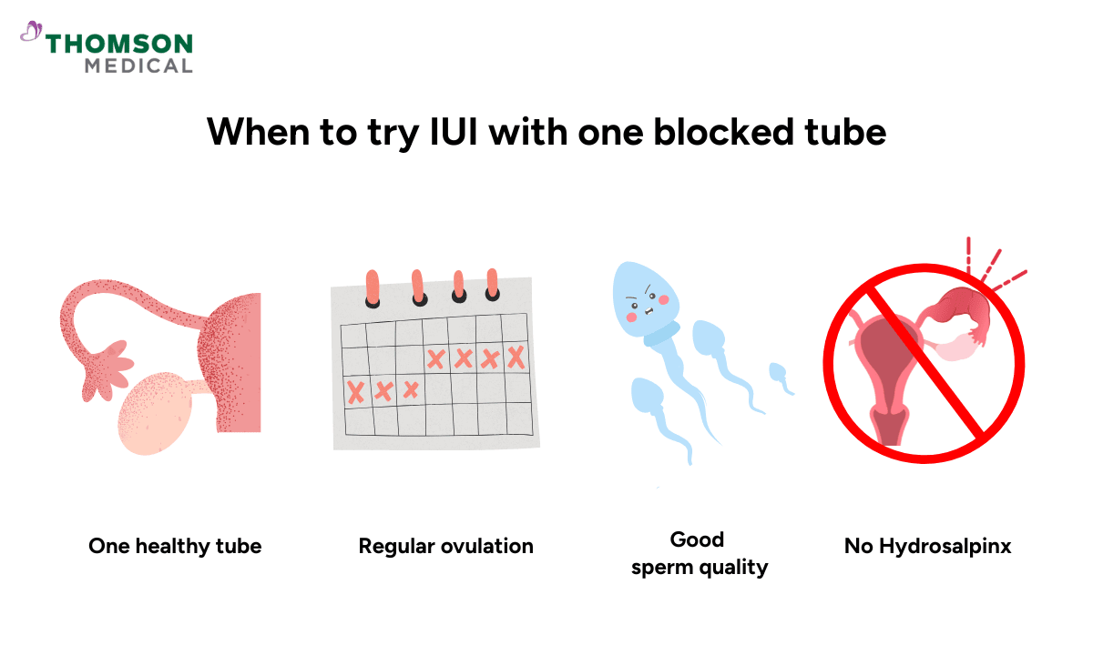 When is IUI recommended with one blocked fallopian tube?