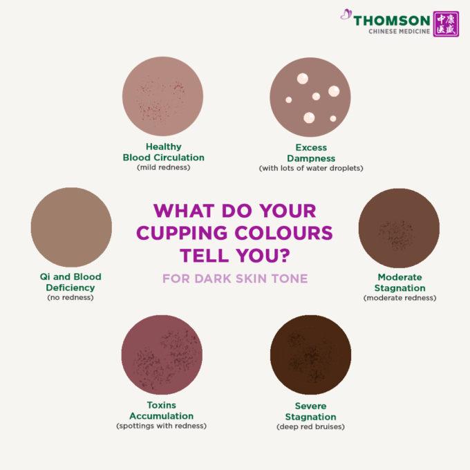 TCM What Do Your Cupping Colours Tell You 3.jpg