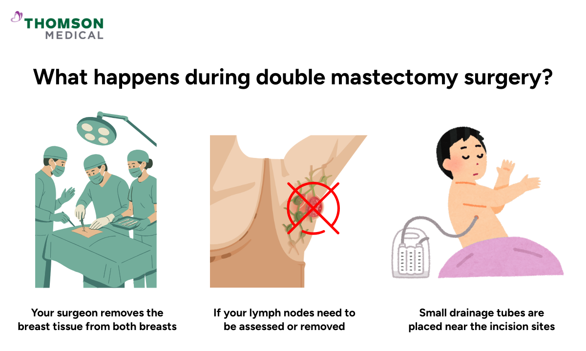 Illustration of what happens during double mastectomy surgery