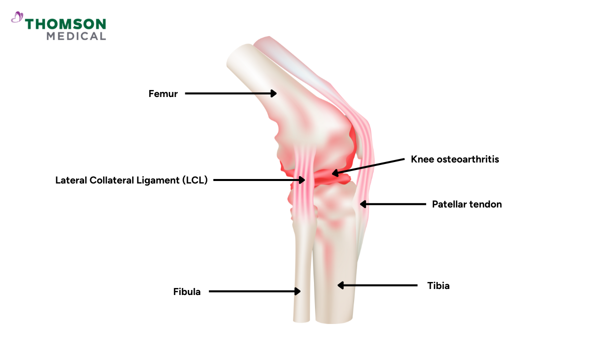 Side illustration of knee osteoarthritis along with knee anatomy
