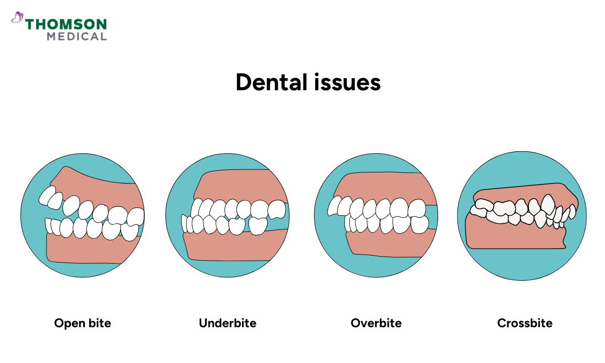 Illustration of dental issues that can be treated with braces