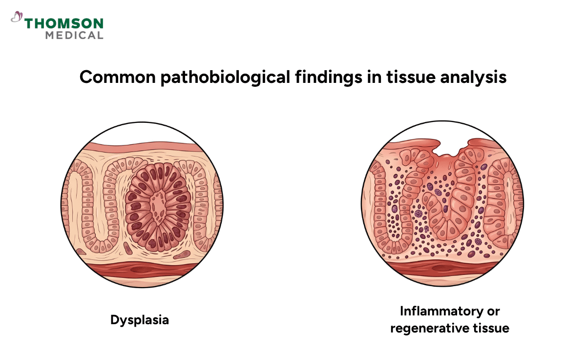 Comparison of pathobiological findings in tissue analysis, showing a microscopic view of Dysplasia (abnormal cell growth) versus Inflammatory or regenerative tissue.
