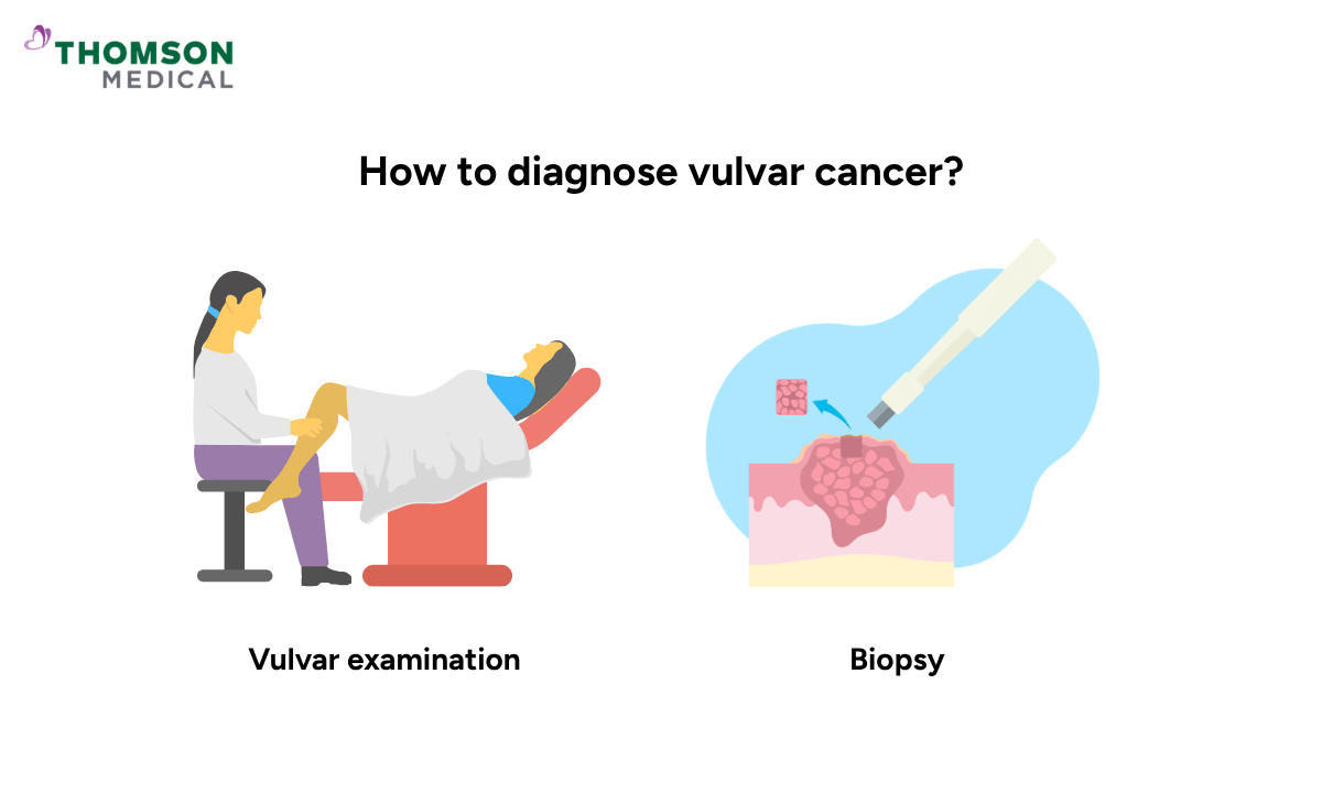 illustration on how to diagnose vulvar cancer