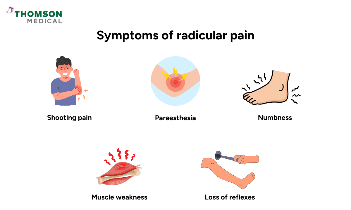 Infographics on symptoms of radicular pain