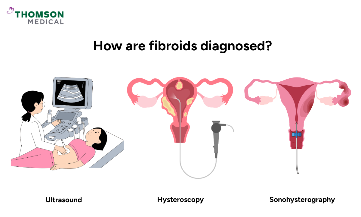 Illustration of how fibroids are diagnosed