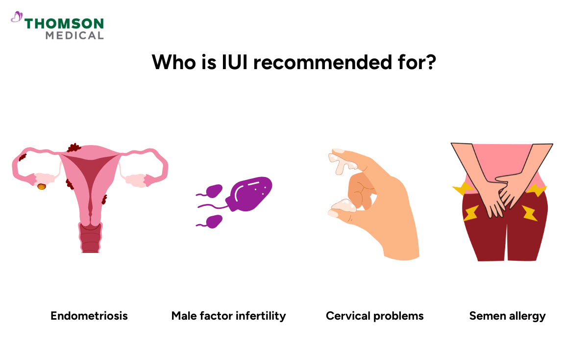 Who is IUI recommended for?