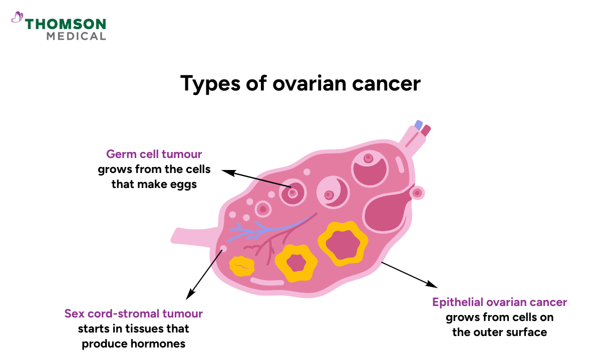 image of ovarian cancer types