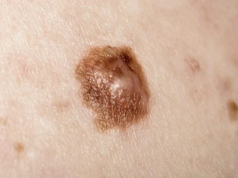 Skin-cancer-1-1-768x576.jpg.webp