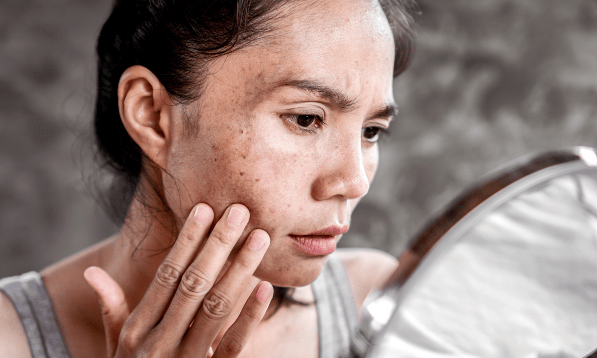 hyperpigmentation prevention