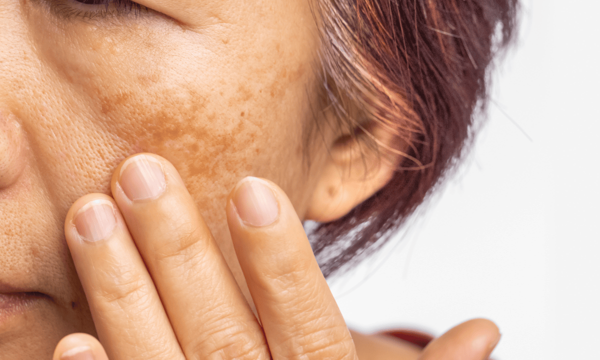 image of ageing skin in women