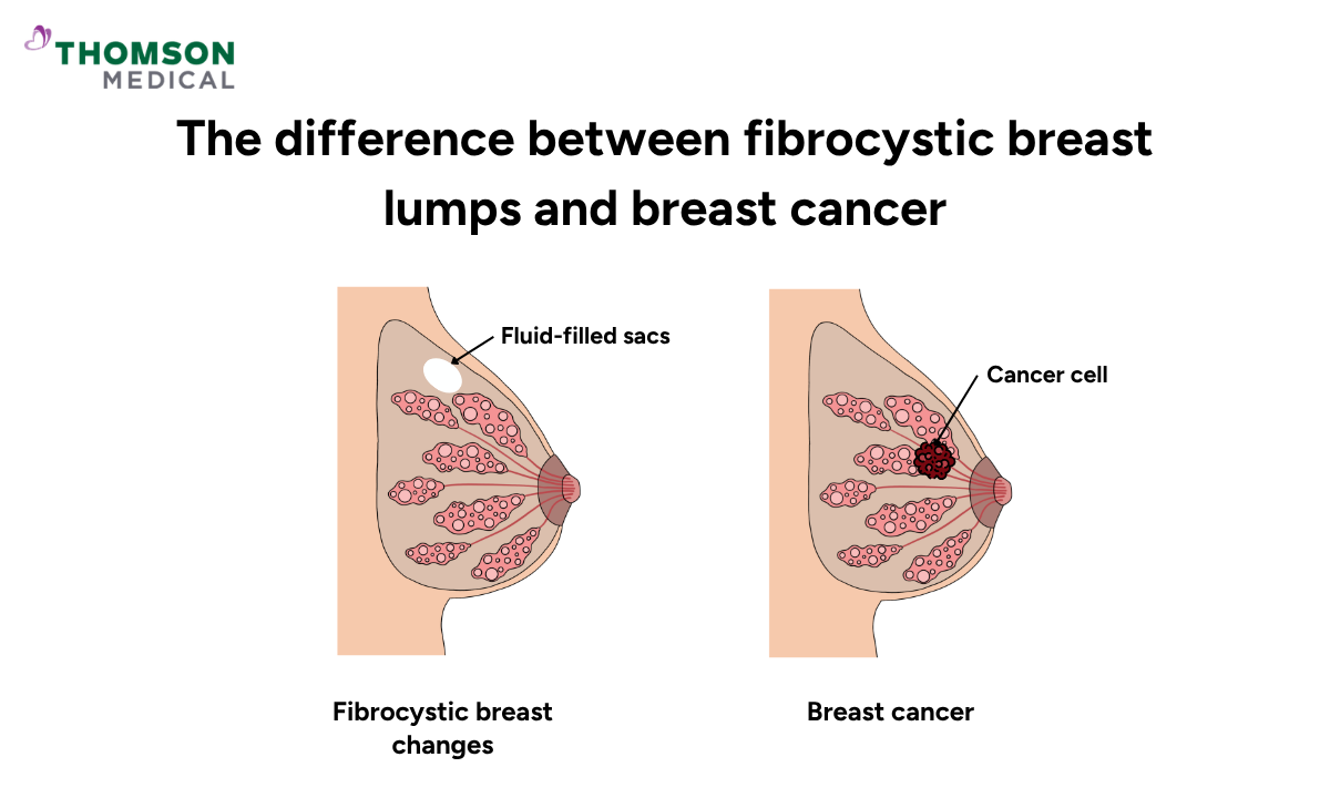 An illustration comparing fibrocystic breast changes and breast cancer