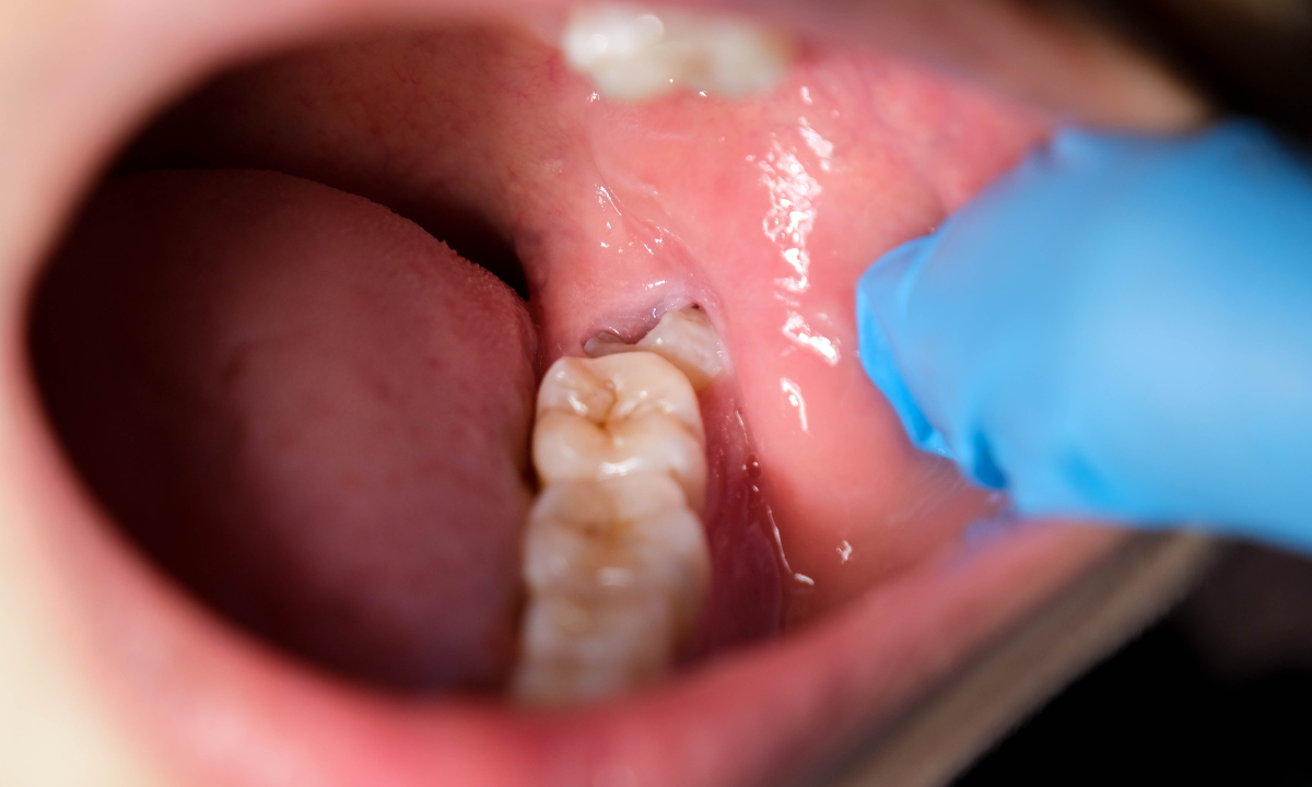 Close-up image of a wisdom tooth