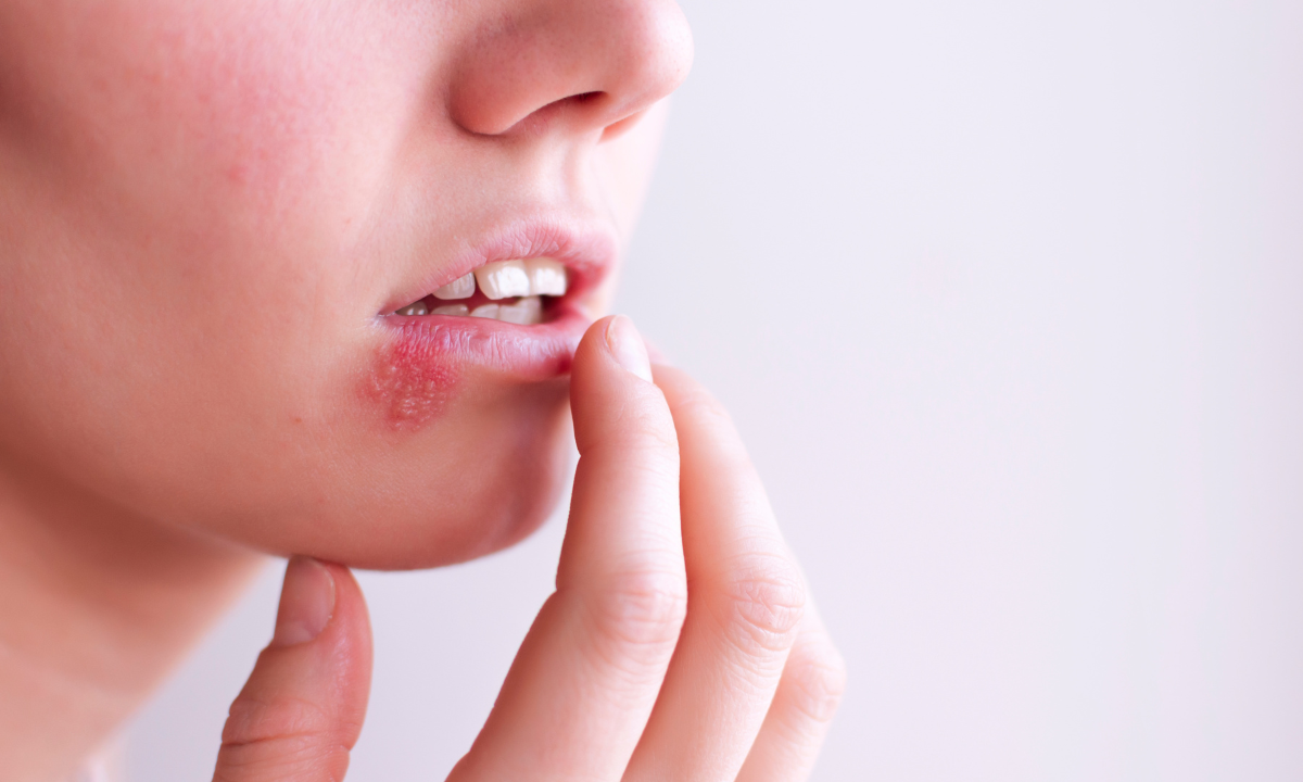 female patient experincing oral herpes