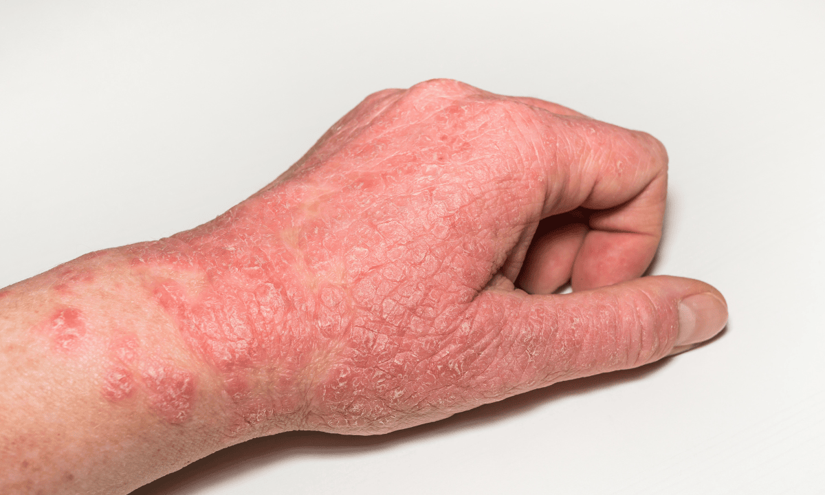 Eczema on hand