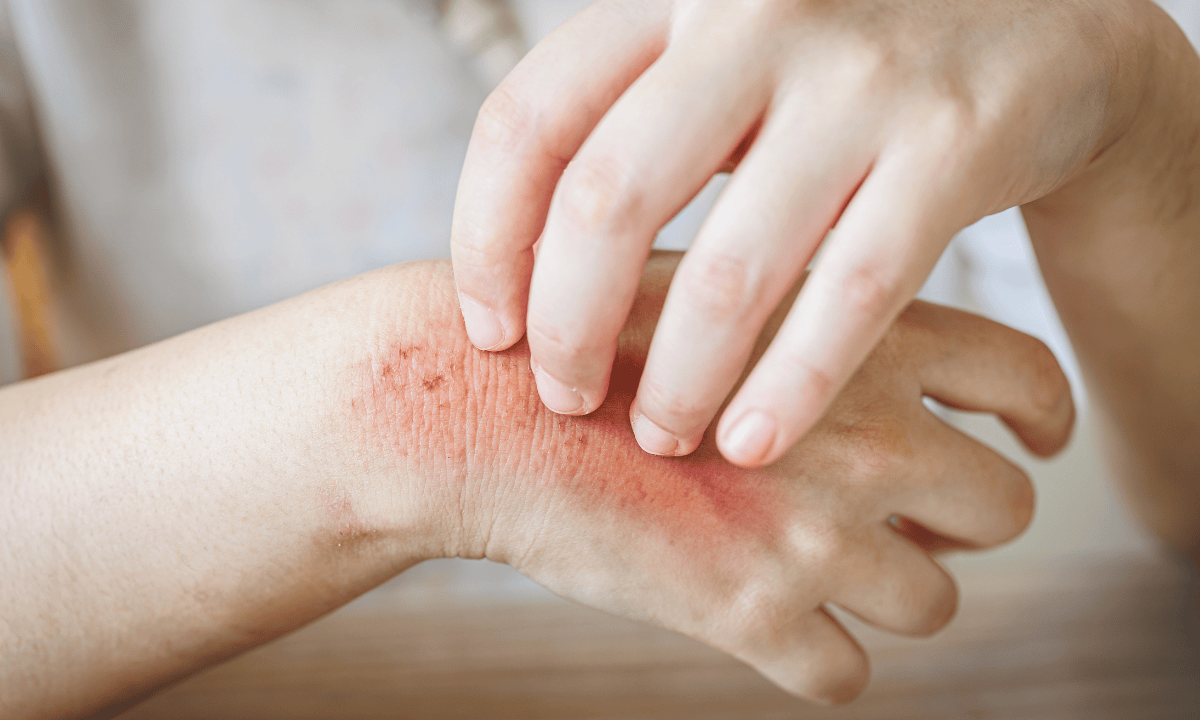 image of an eczema in hand
