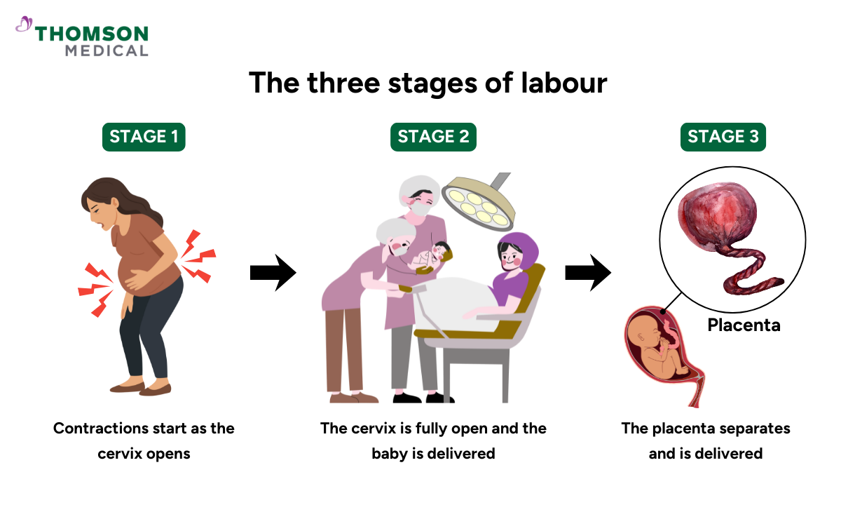 Illustration of the three stages of labour