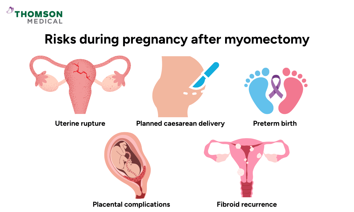 image of risks during pregnancy after myomectomy