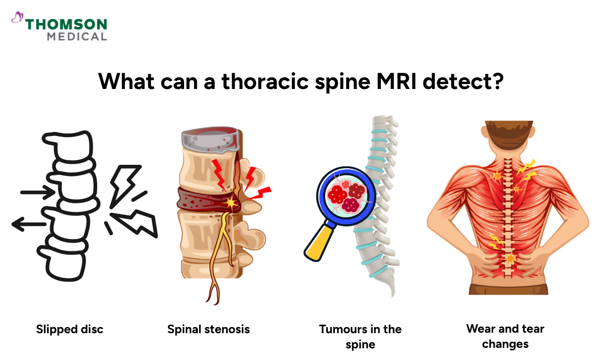 Illustration of why your doctor might recommend a thoracic spine MRI
