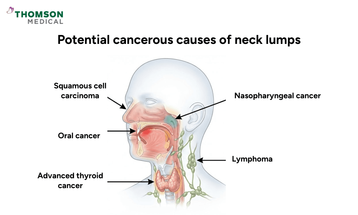 Basic illustration of the body parts corresponding to potential cancerous causes of neck lumps