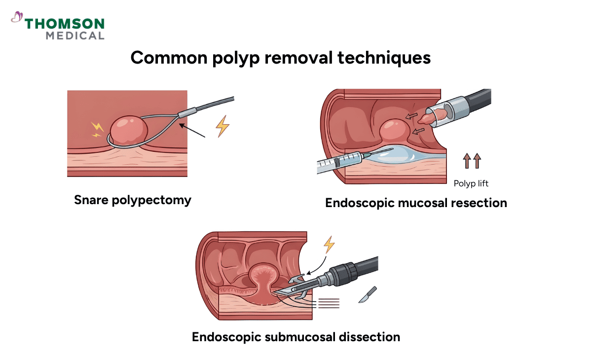 three polyp removal techniques