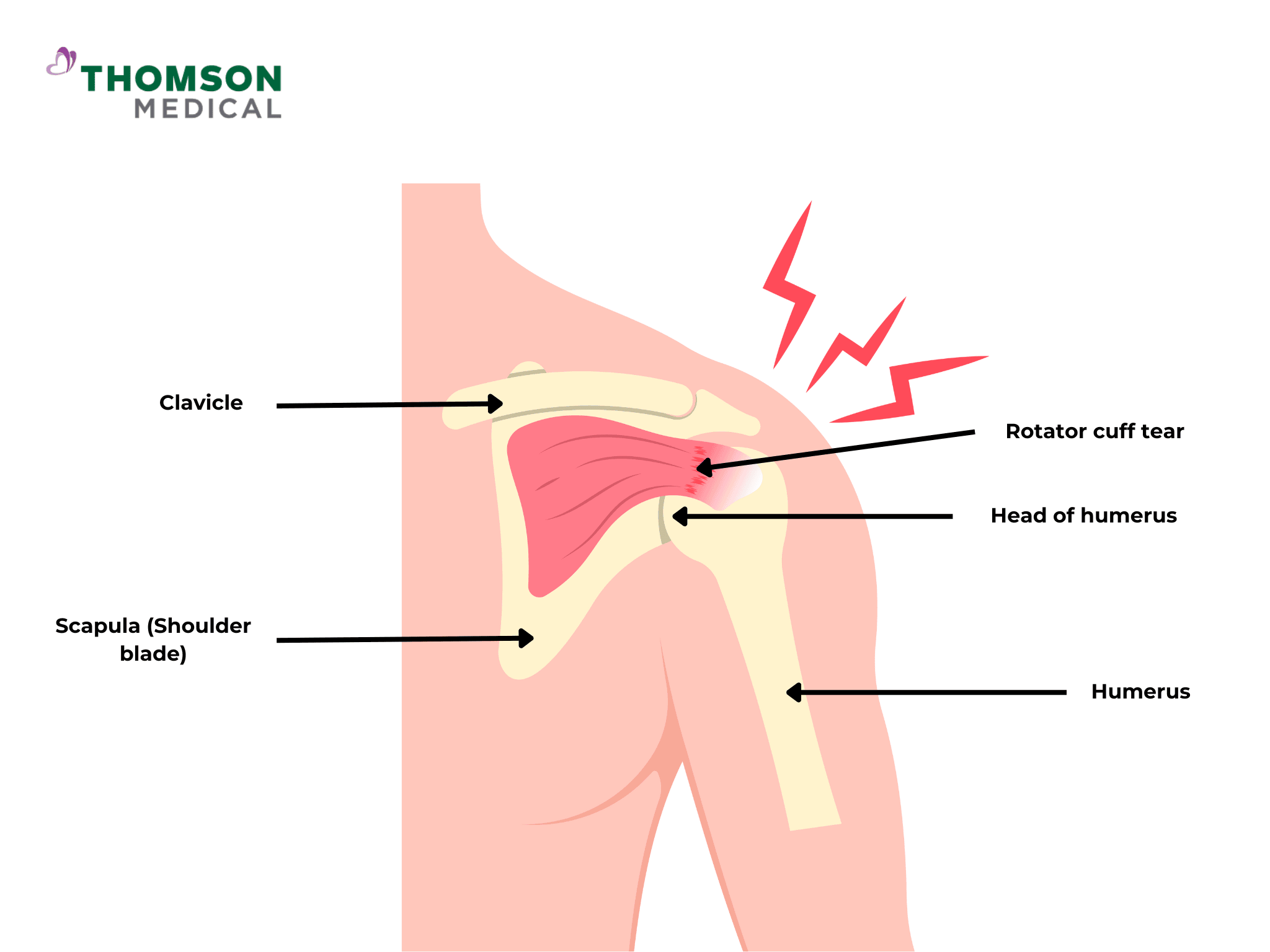 Rotator cuff tear, humerus