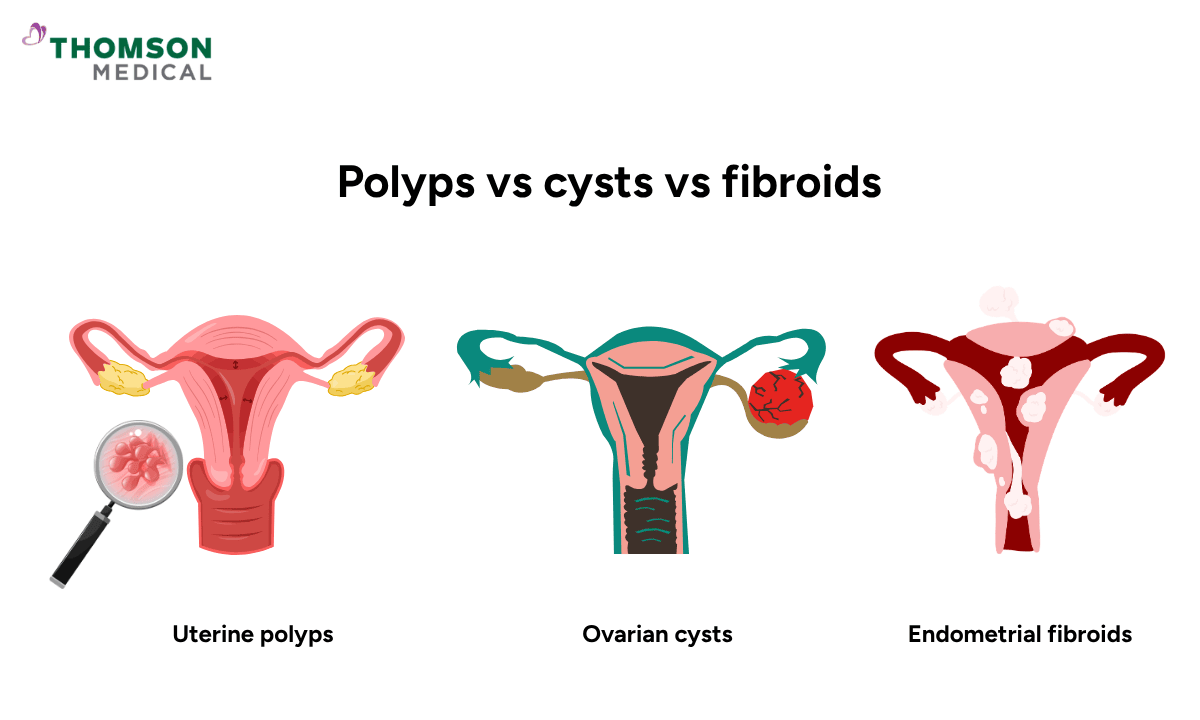 image of polyps vs cysts vs fibroids