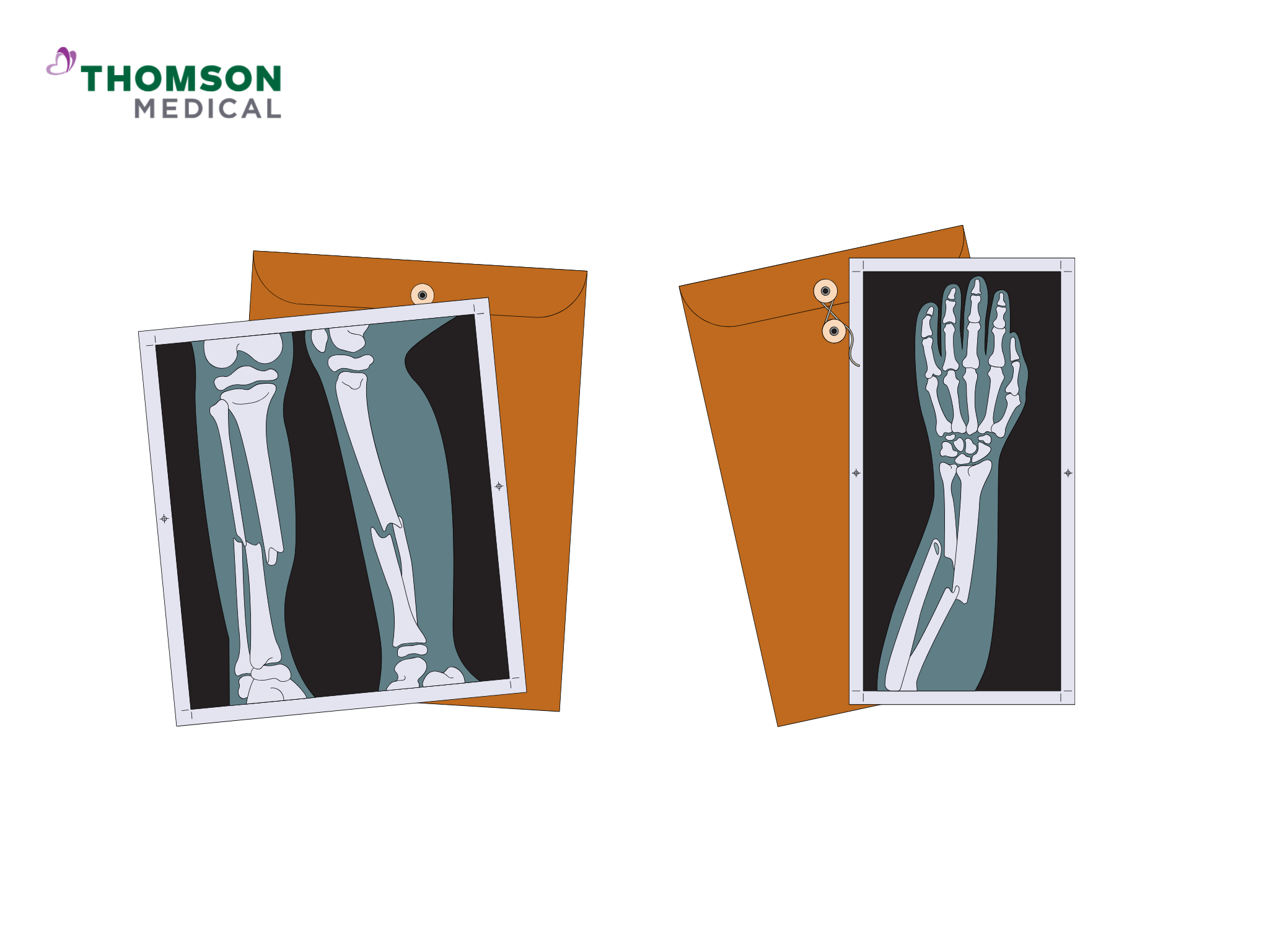 x-ray illustration of orthopaedic fracture, leg fracture illustration, illustration of hand fracture