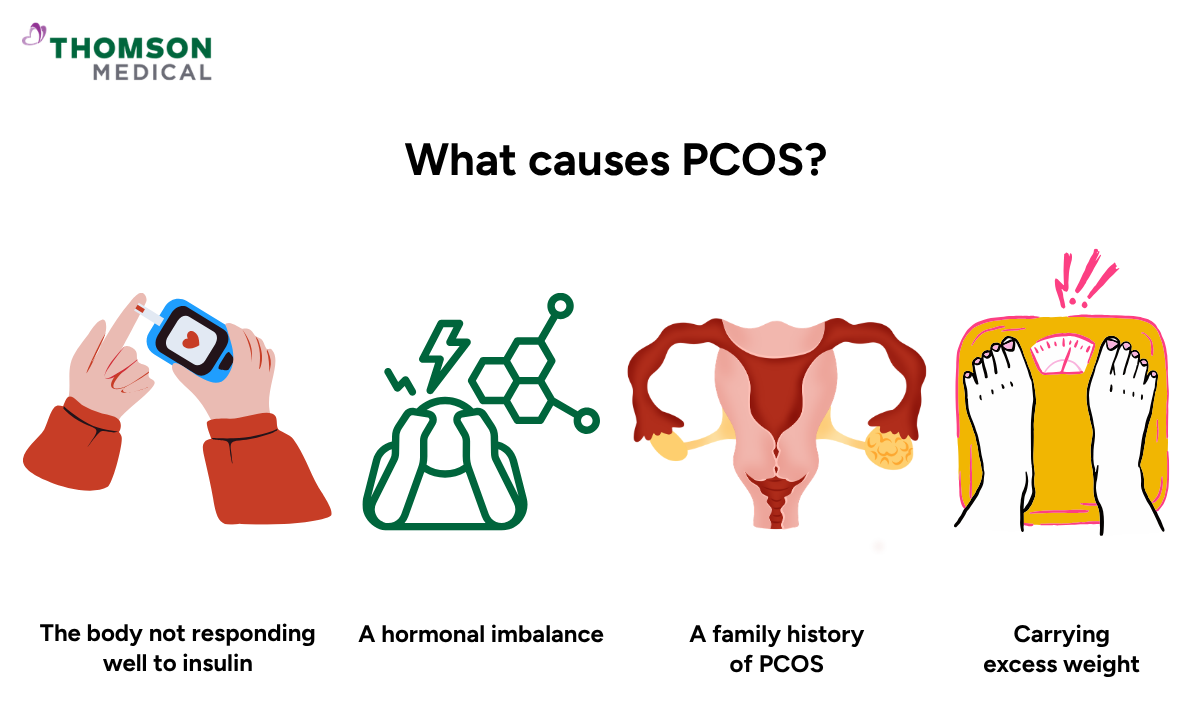 Illustration of causes of PCOS