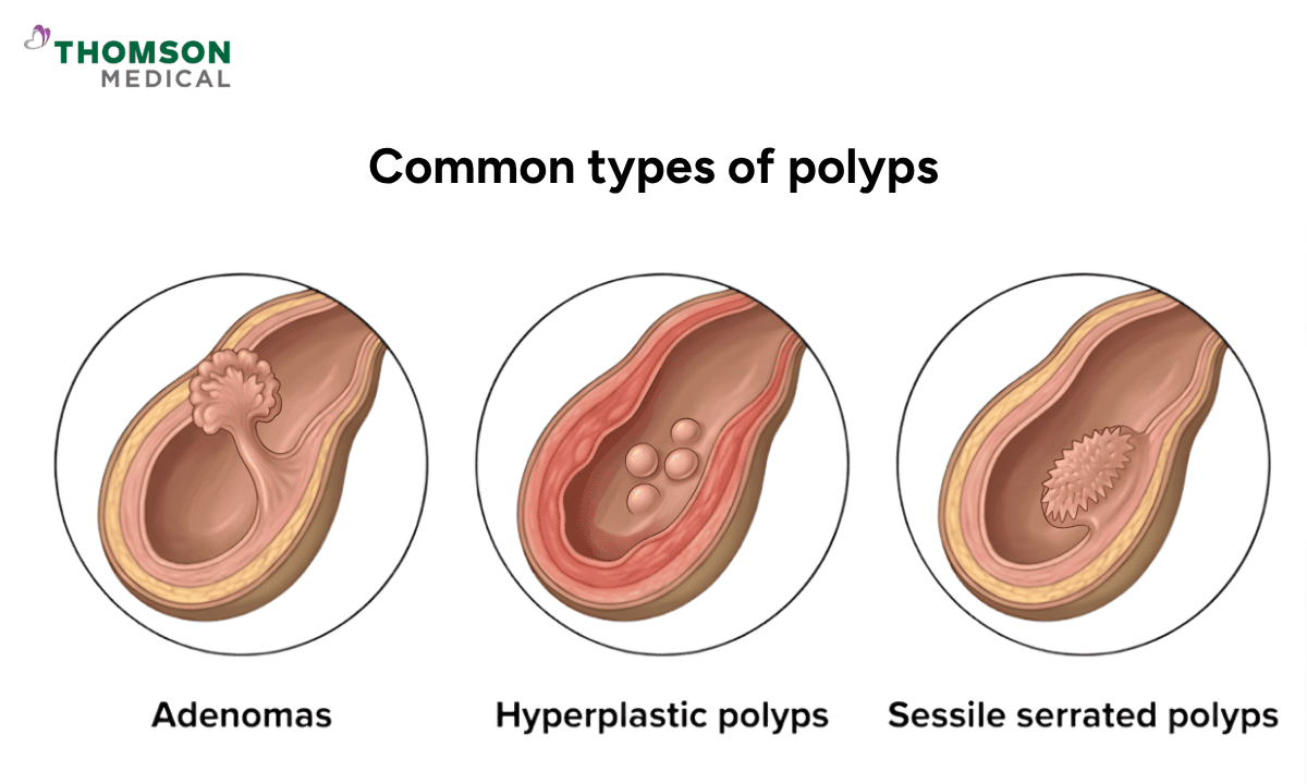 three common types of polyps