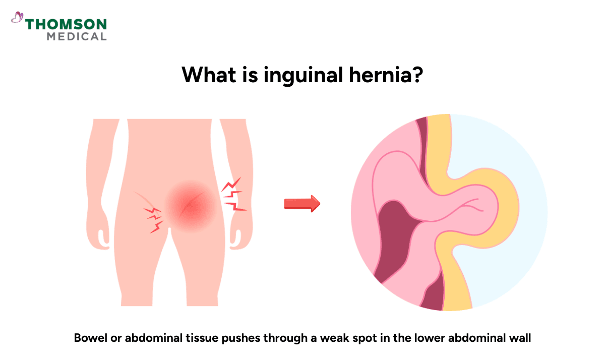 image of inguinal hernia