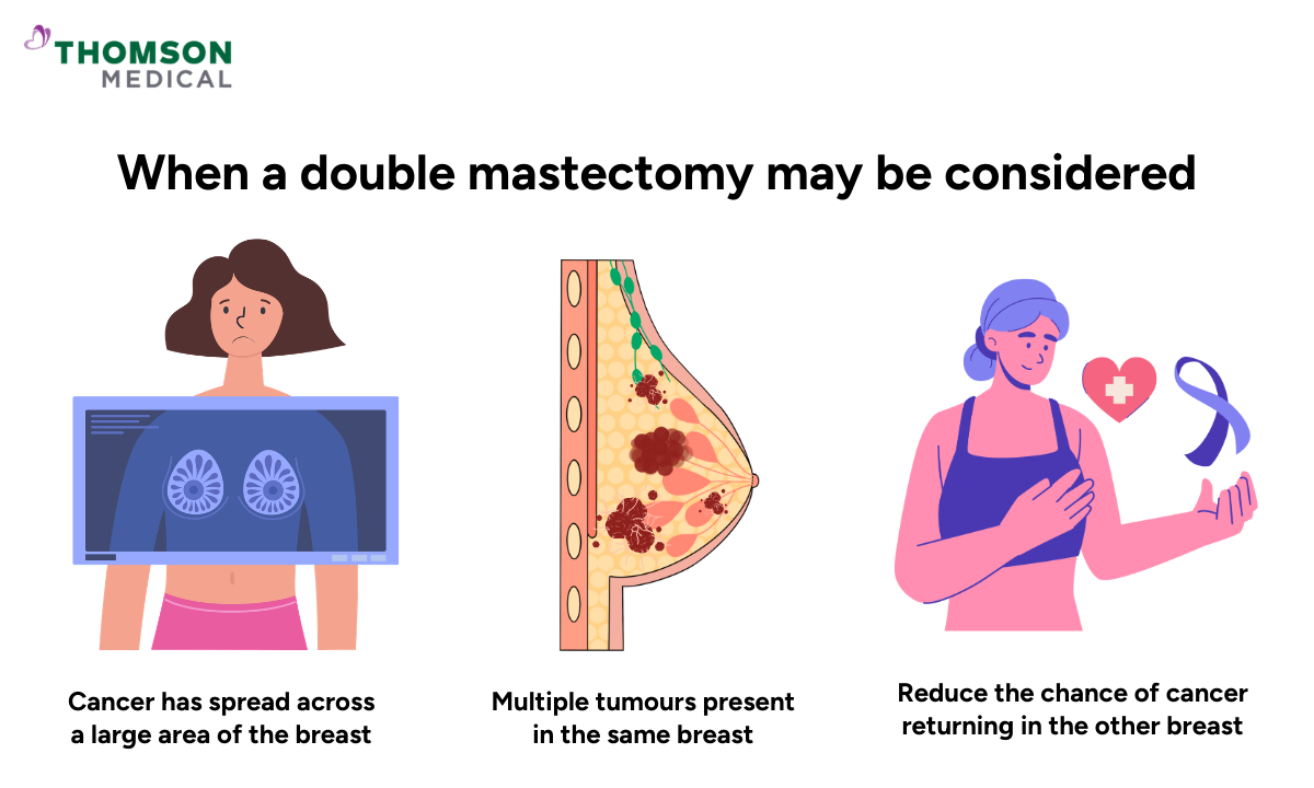 Illustration of who should consider a double mastectomy