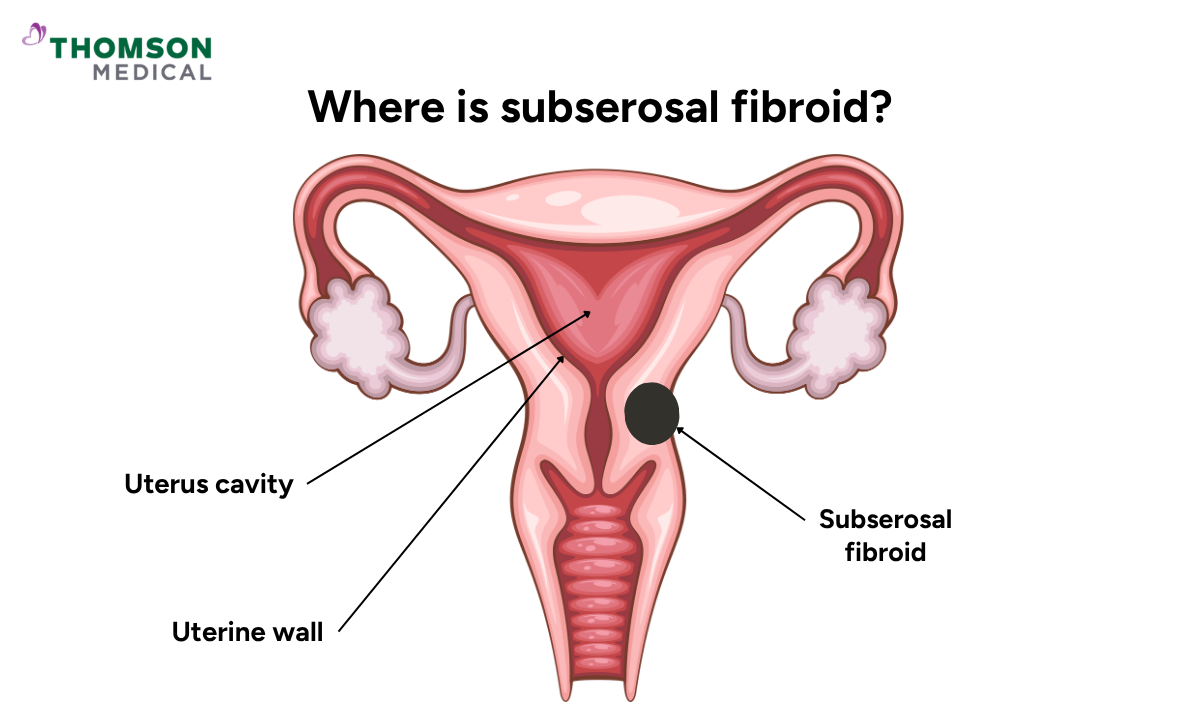 Illustration shows the subserosal fibroid