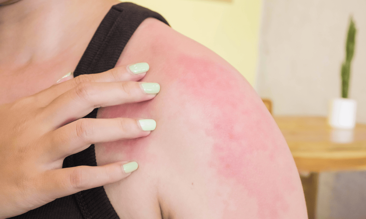 Skin after laser treatment