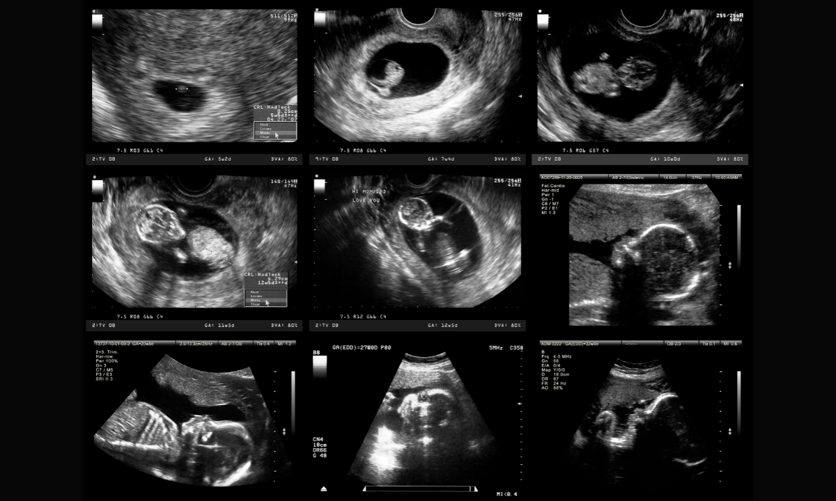 blog-image_obgyn_ultrasound baby development.png